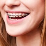 Braces in San Francisco