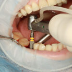 Cosmetic Dental Implants