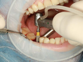 Cosmetic Dental Implants