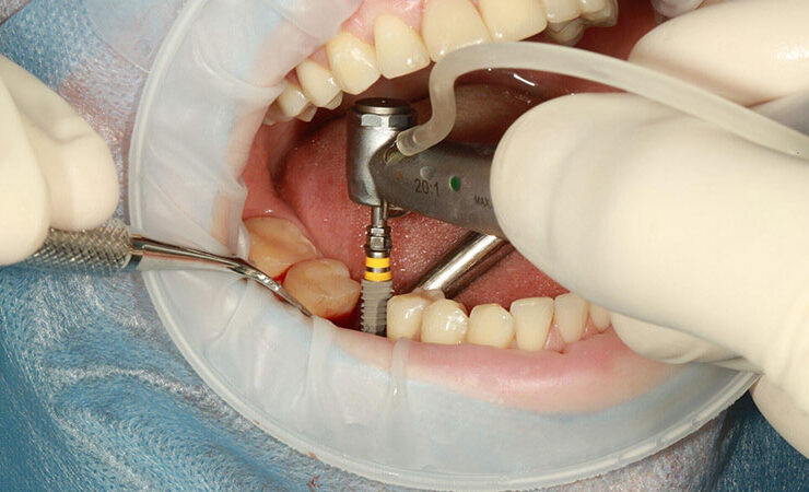 Cosmetic Dental Implants