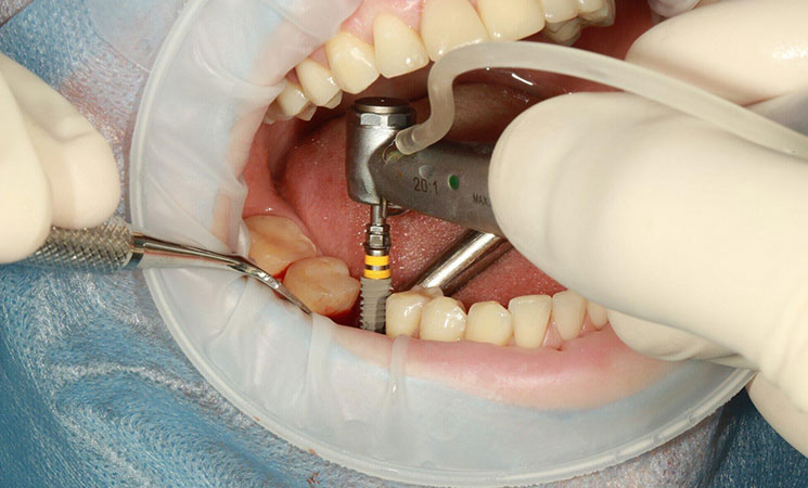 Cosmetic Dental Implants