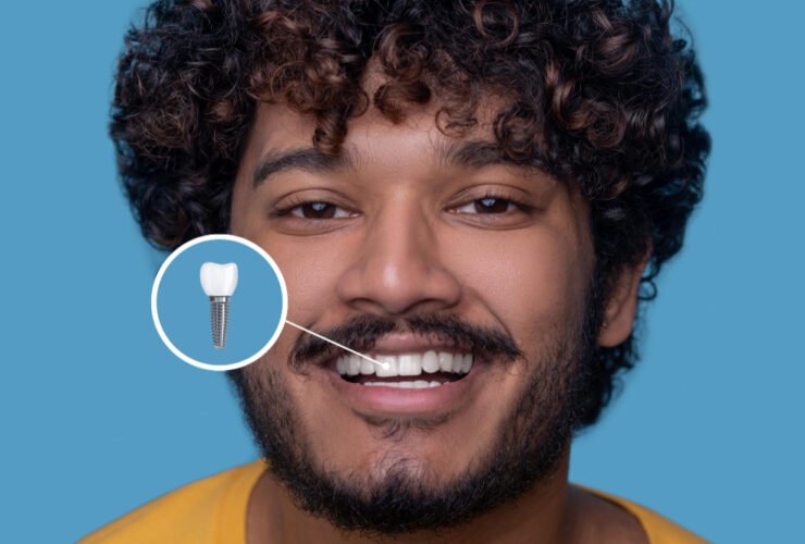 Dental Implants