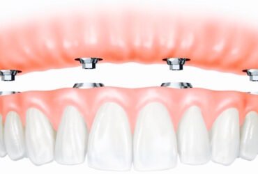 Fixed denture implant procedure using intraoral scanner in North York
