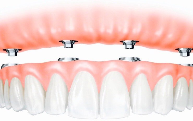 Fixed denture implant procedure using intraoral scanner in North York