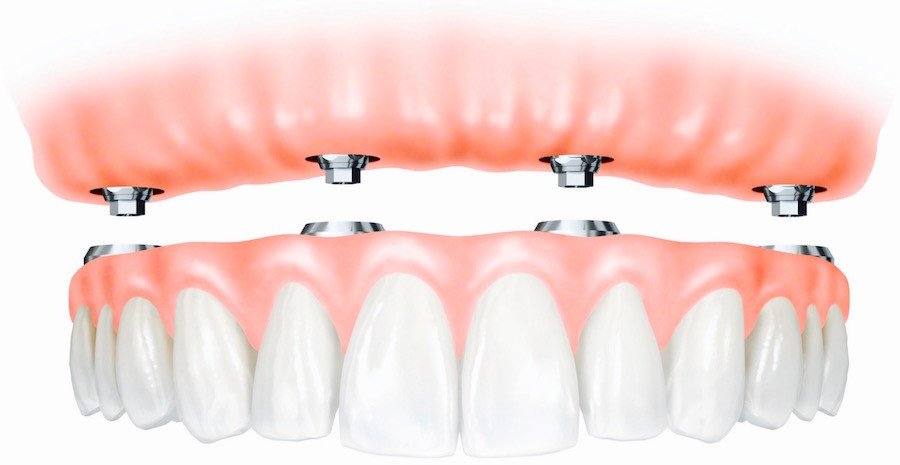 Fixed denture implant procedure using intraoral scanner in North York