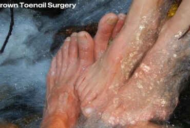 Ingrown Toenail Surgery