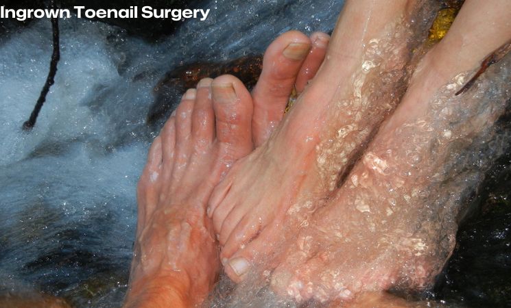 Ingrown Toenail Surgery