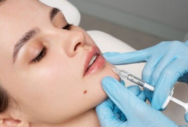 Lip Augmentation