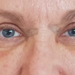 Recovery After Upper Eyelid Surgery