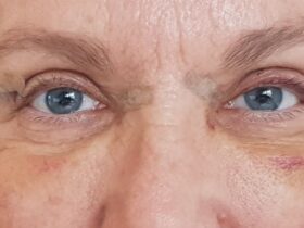 Recovery After Upper Eyelid Surgery