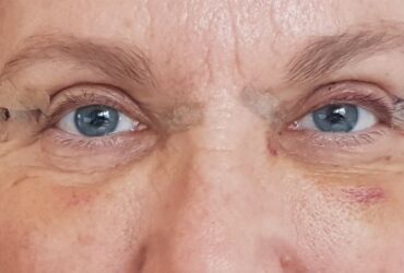 Recovery After Upper Eyelid Surgery