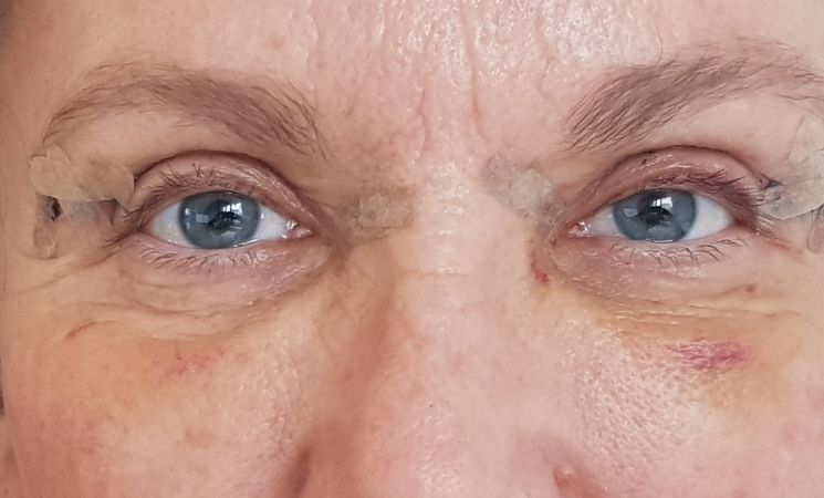 Recovery After Upper Eyelid Surgery