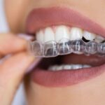 clear aligners