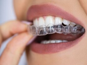 clear aligners