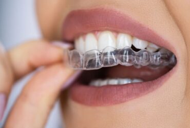 clear aligners