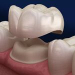 dental crowns