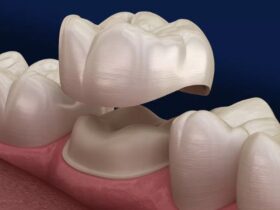 dental crowns