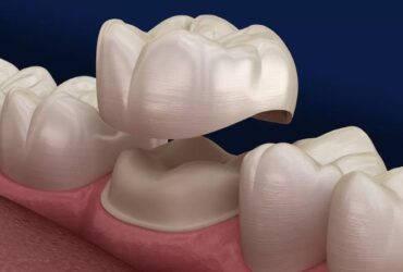 dental crowns