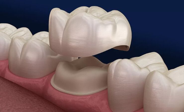 dental crowns