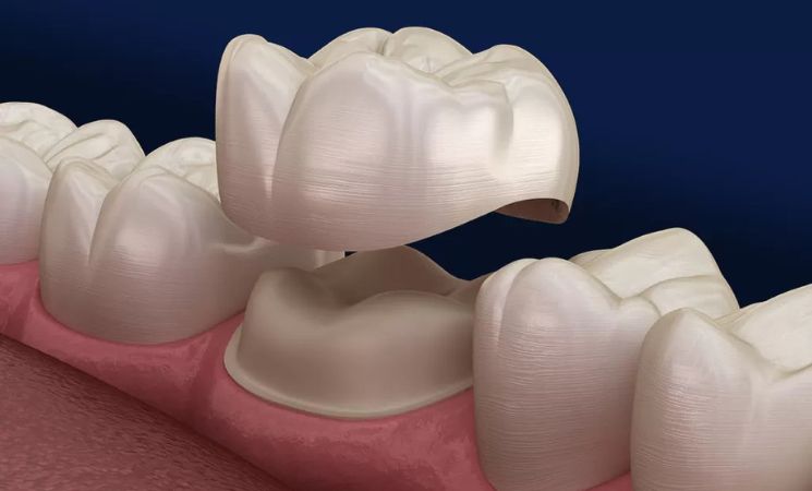 dental crowns