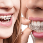 Clear Aligners vs Braces