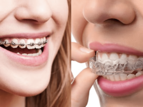 Clear Aligners vs Braces