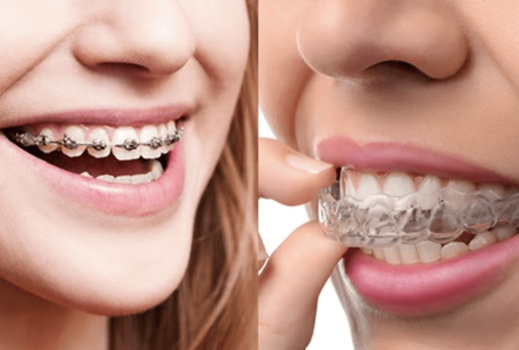 Clear Aligners vs Braces