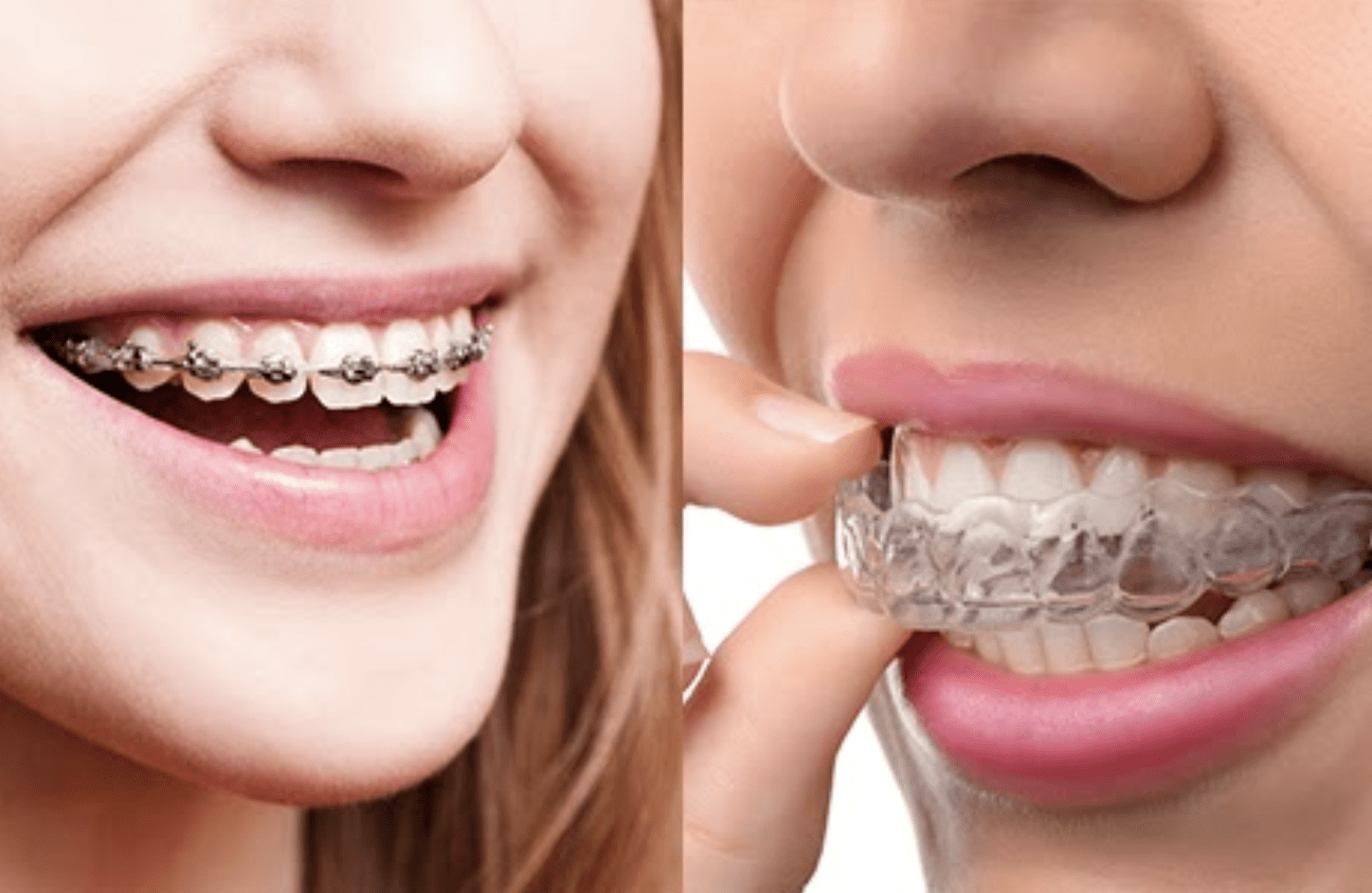 Clear Aligners vs Braces